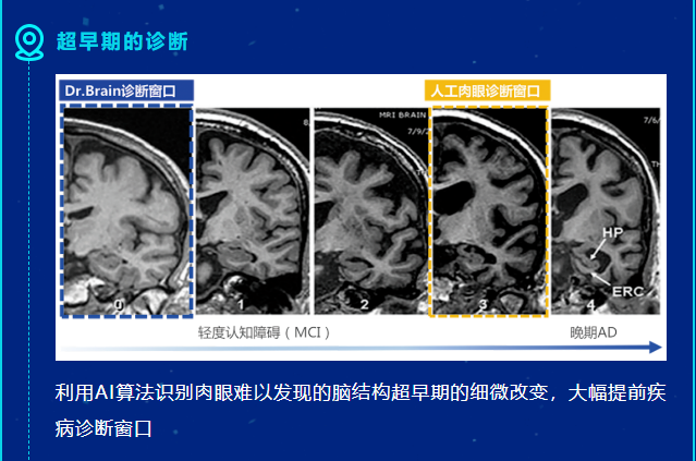 重磅消息！医未医疗获批全国首张阿尔茨海默病AI辅助诊断NMPA三类证